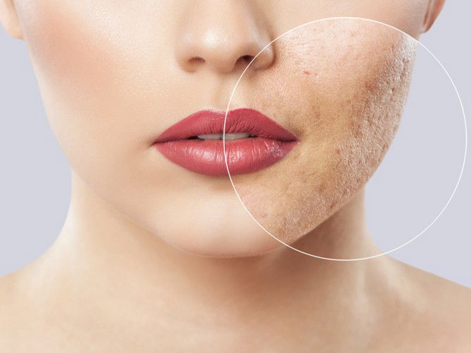 Types of Acne and How to Treat Them