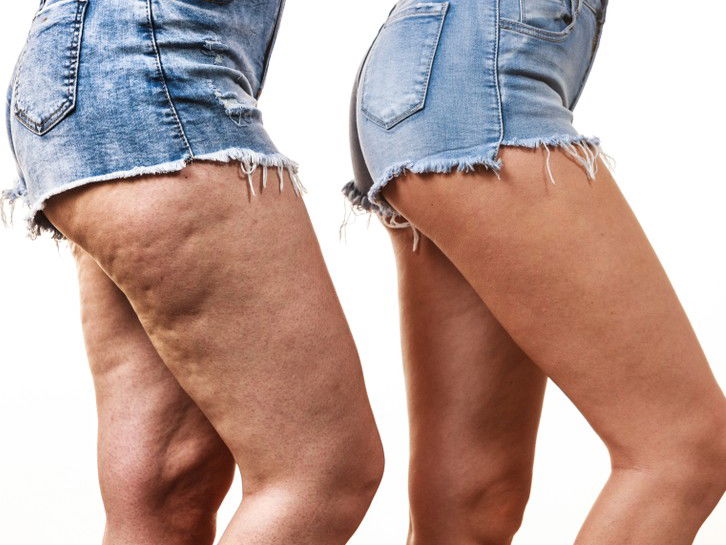 Everything You Need to Know About Getting Rid of Cellulite