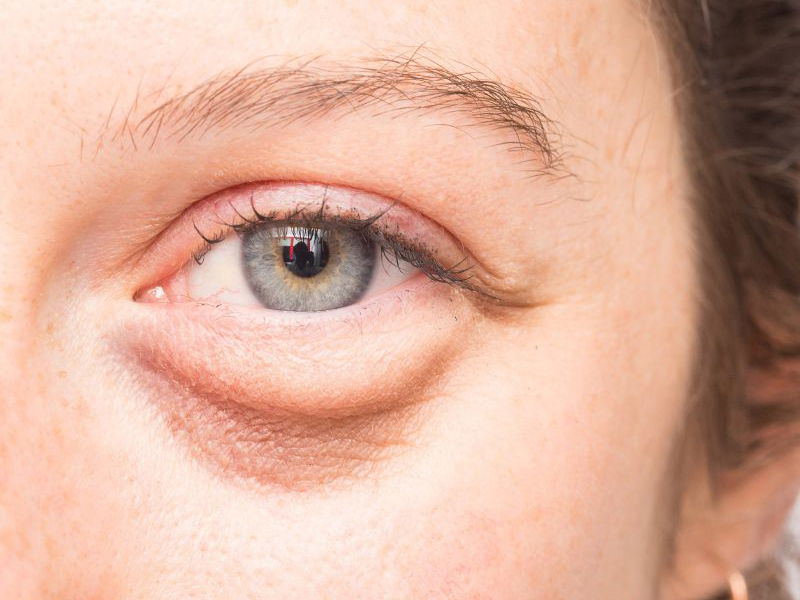 7 Things That Can Cause Under Eye Puffiness and Dark Circles